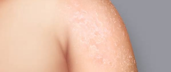 Tør hud (xerose) |